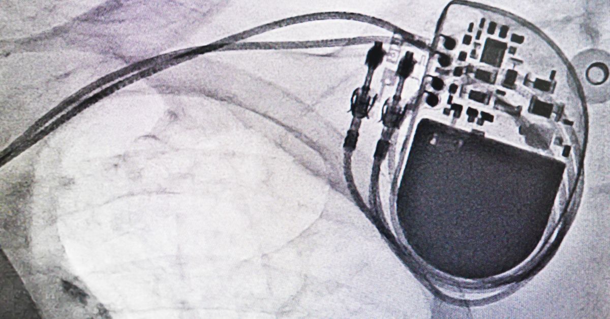 How Pacemakers Work: A Technical Overview